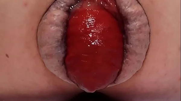 Contender For Biggest Prolapse (Male Warning!)